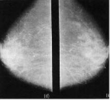 डाव्या व उजव्या स्तनांची पार्श्वदृश्ये दर्शविणारी स्तनग्रंथीदर्शक प्रतिमा